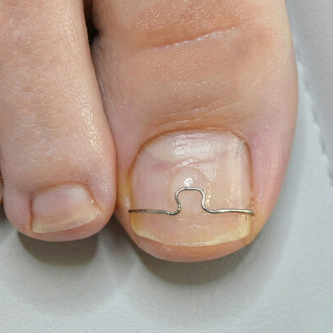 Corectarea unghiei încarnate cu fir de titan